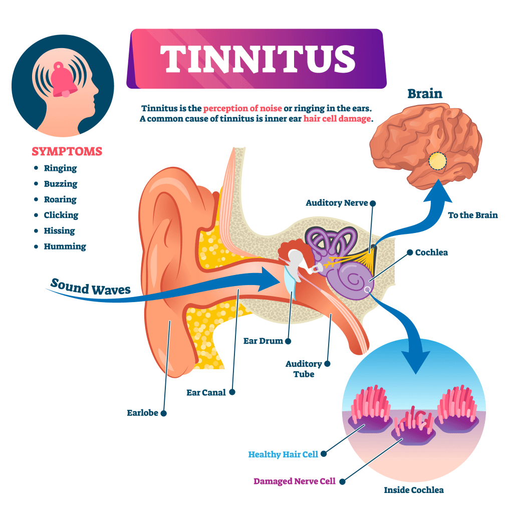 \"tinnitus